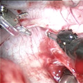 endoscopic view in a mini-invasive roboticaly assisted operation