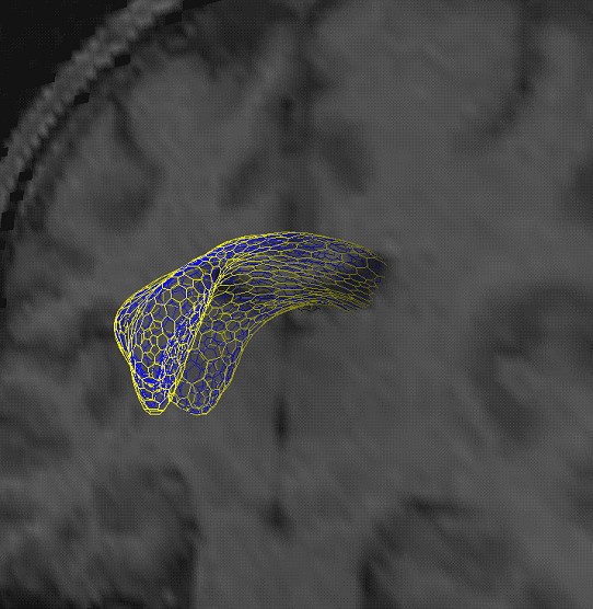 bounds on ventricle